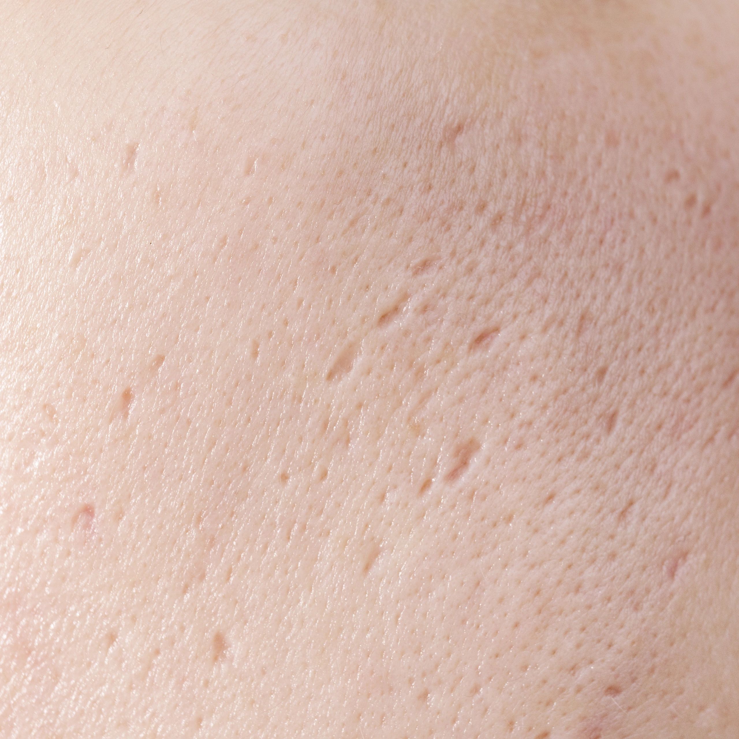 Close-up skin texture for microneedling treatment