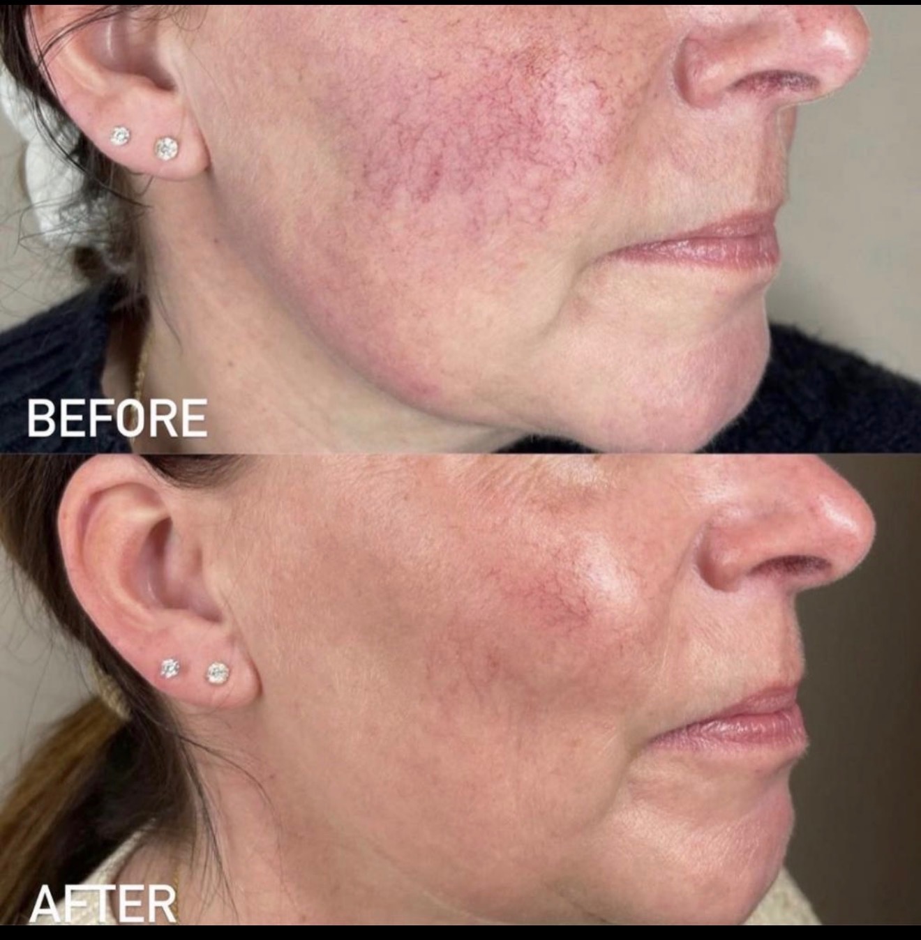 Before-and-after side-profile comparison showing improvement in facial redness and texture following photofacial treatment