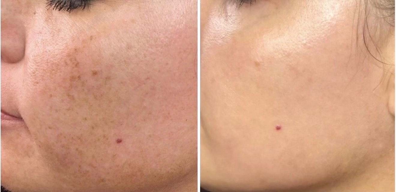 Before-and-after close-up showing improvement in uneven skin tone and pigmentation following photofacial treatment