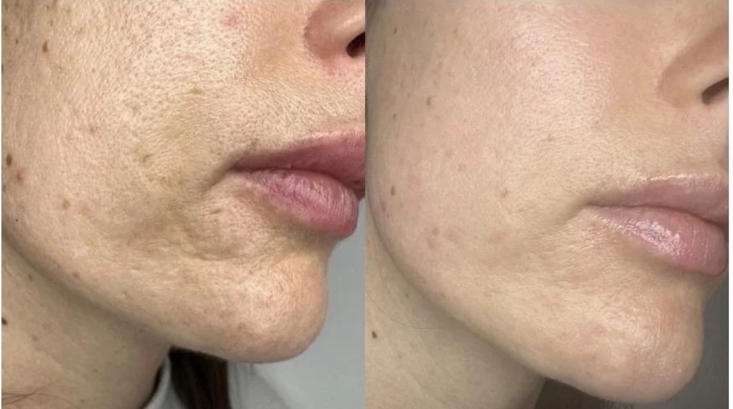 Before-and-after close-up showing changes in facial skin texture and tone following Pixel Resurfacing treatment